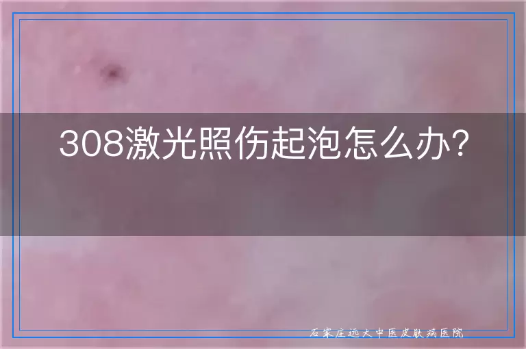 308激光照伤起泡怎么办？