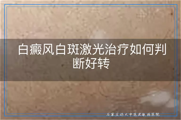 白癜风白斑激光治疗如何判断好转