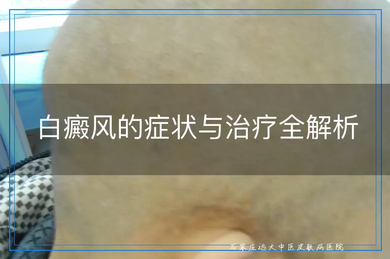 白癜风的症状与治疗全解析