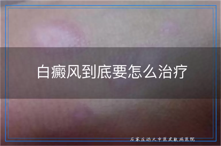 白癜风到底要怎么治疗