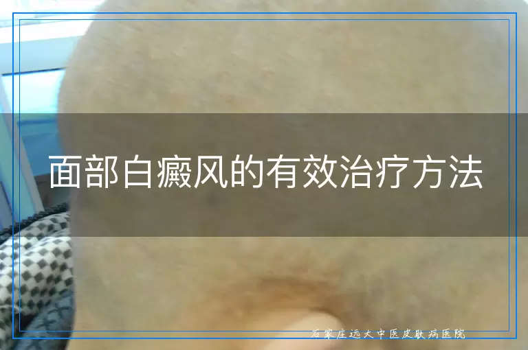 面部白癜风的有效治疗方法