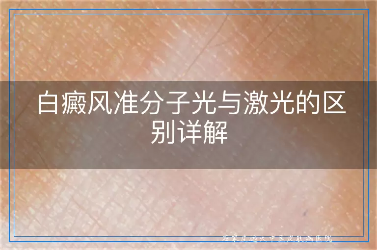 白癜风准分子光与激光的区别详解