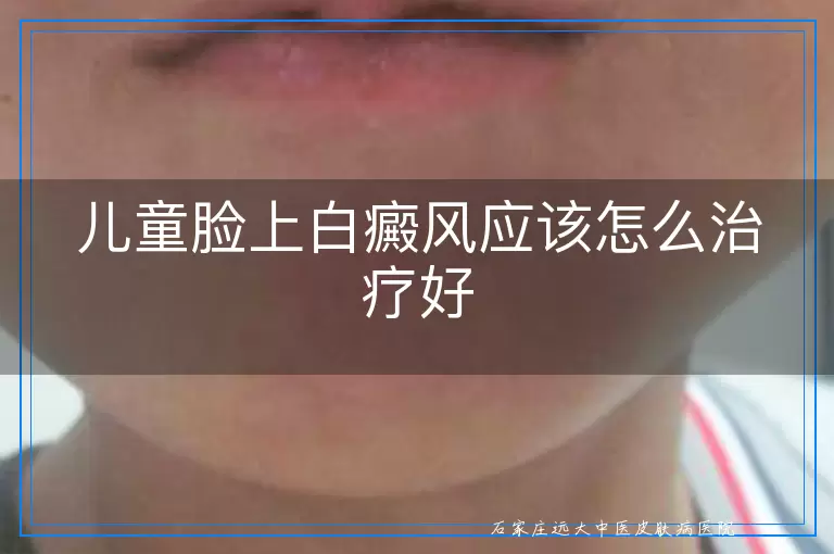 儿童脸上白癜风应该怎么治疗好