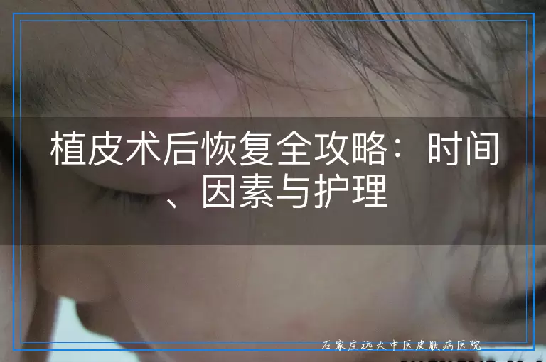 植皮术后恢复全攻略：时间、因素与护理