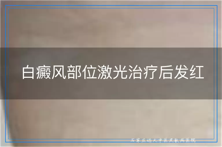 白癜风部位激光治疗后发红