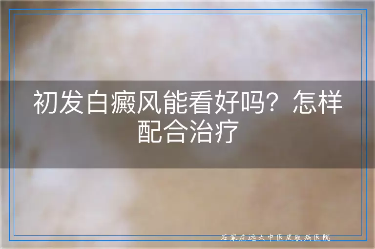 初发白癜风能看好吗？怎样配合治疗
