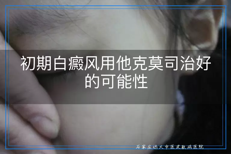 初期白癜风用他克莫司治好的可能性