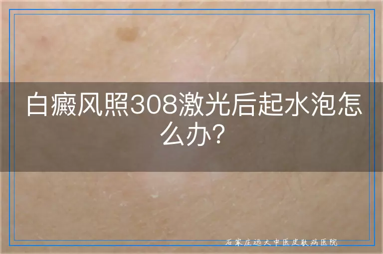 白癜风照308激光后起水泡怎么办？