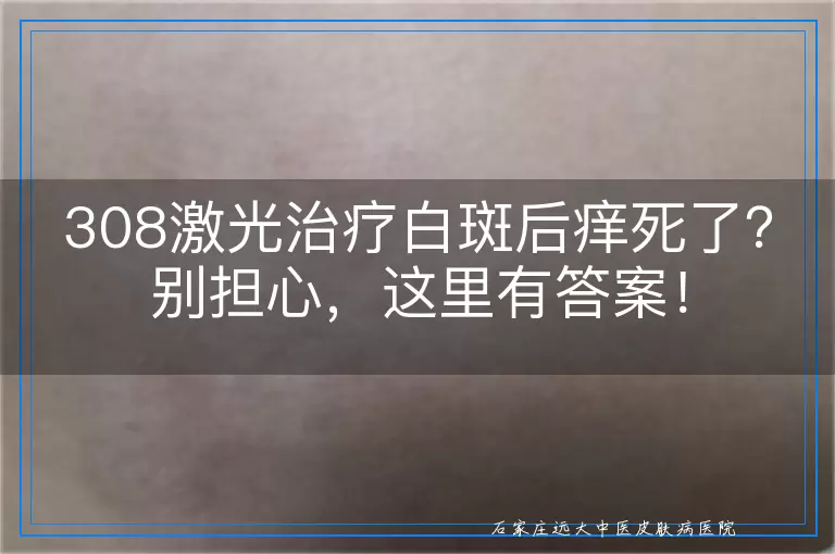 308激光治疗白斑后痒死了？别担心，这里有答案！
