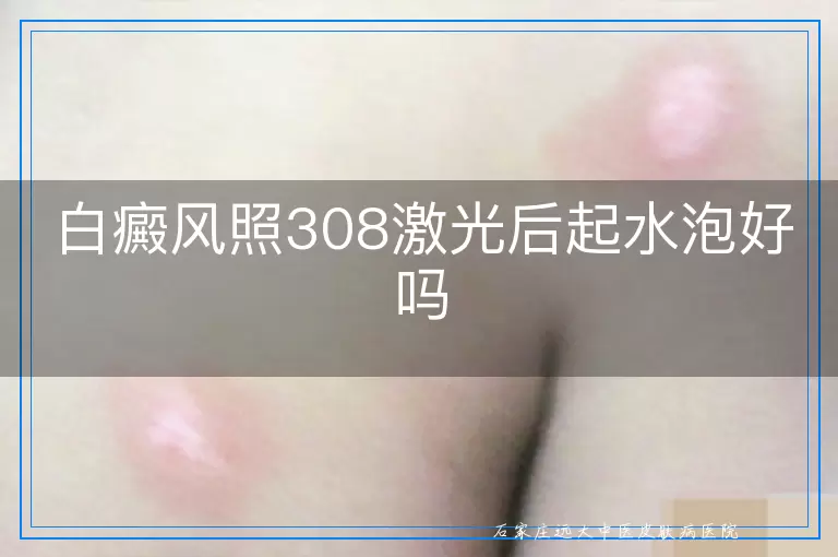 白癜风照308激光后起水泡好吗