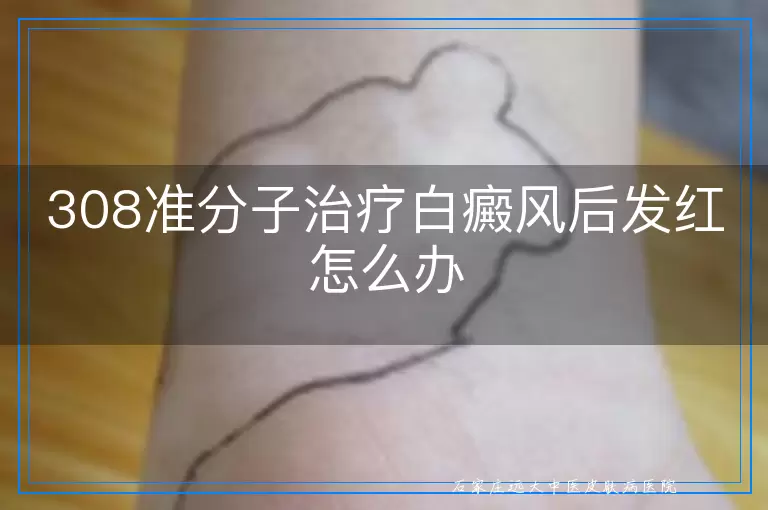 308准分子治疗白癜风后发红怎么办
