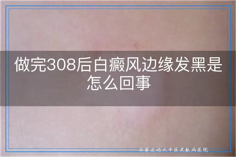 做完308后白癜风边缘发黑是怎么回事