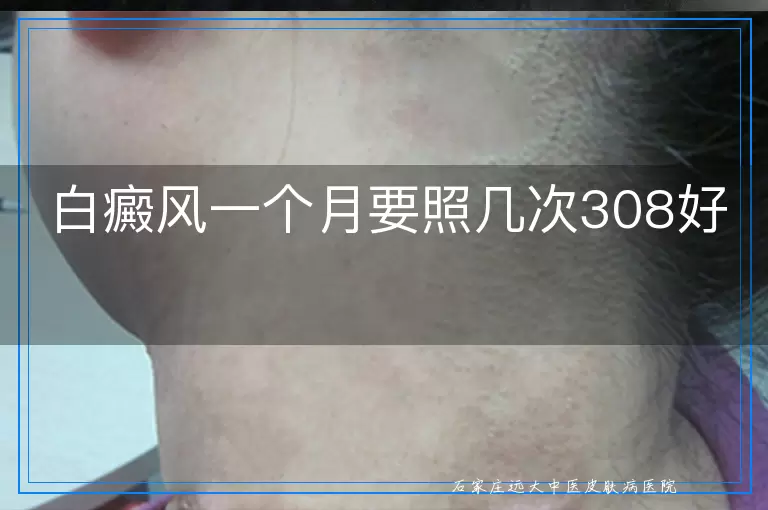 白癜风一个月要照几次308好