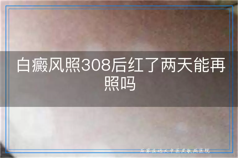 白癜风照308后红了两天能再照吗