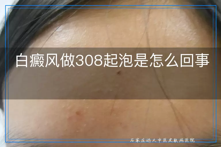 白癜风做308起泡是怎么回事