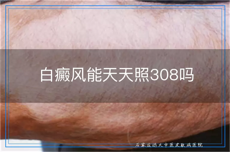 白癜风能天天照308吗