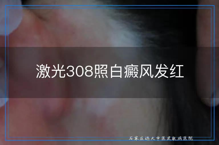 激光308照白癜风发红
