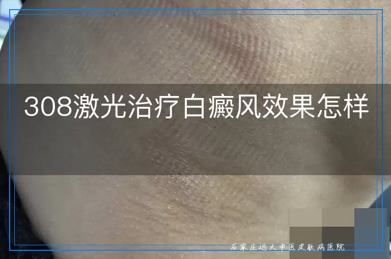 308激光治疗白癜风效果怎样