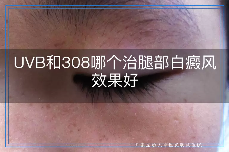 UVB和308哪个治腿部白癜风效果好