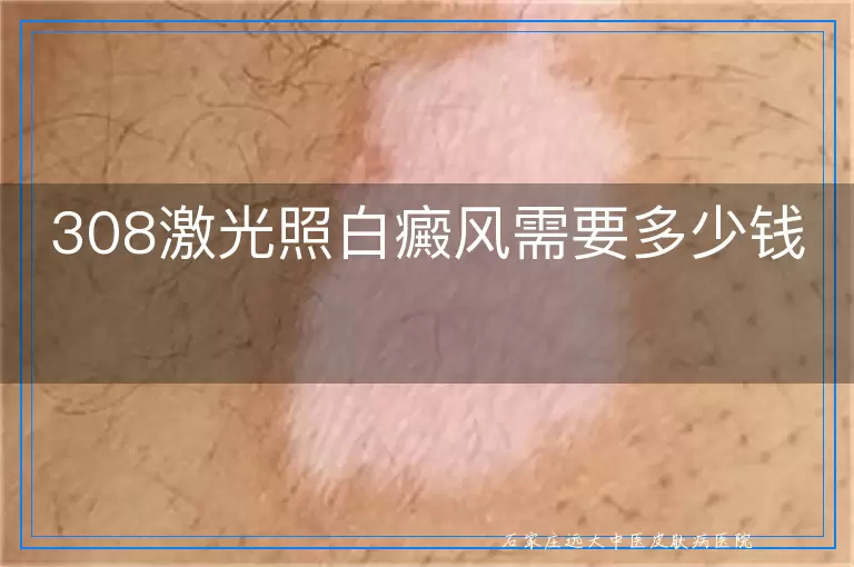 308激光照白癜风需要多少钱