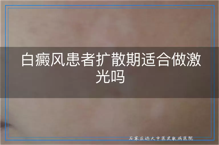白癜风患者扩散期适合做激光吗