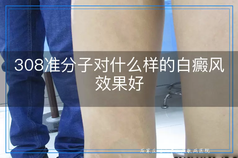 308准分子对什么样的白癜风效果好