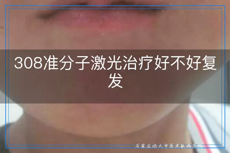 308准分子激光治疗好不好复发