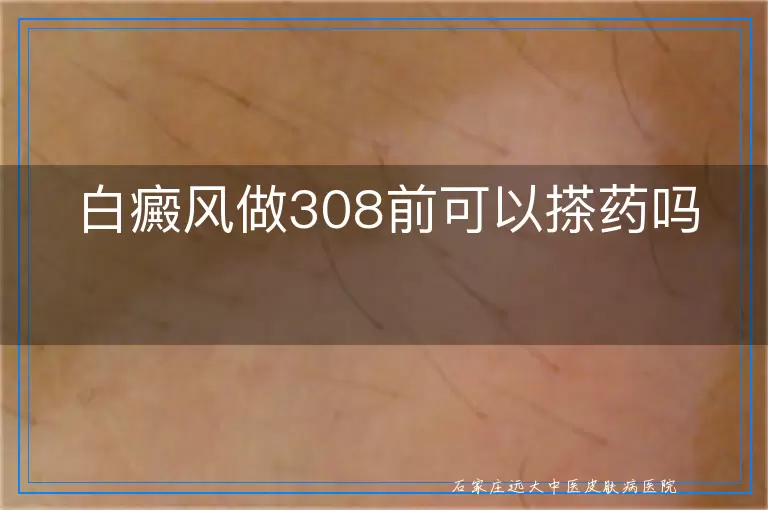 白癜风做308前可以搽药吗