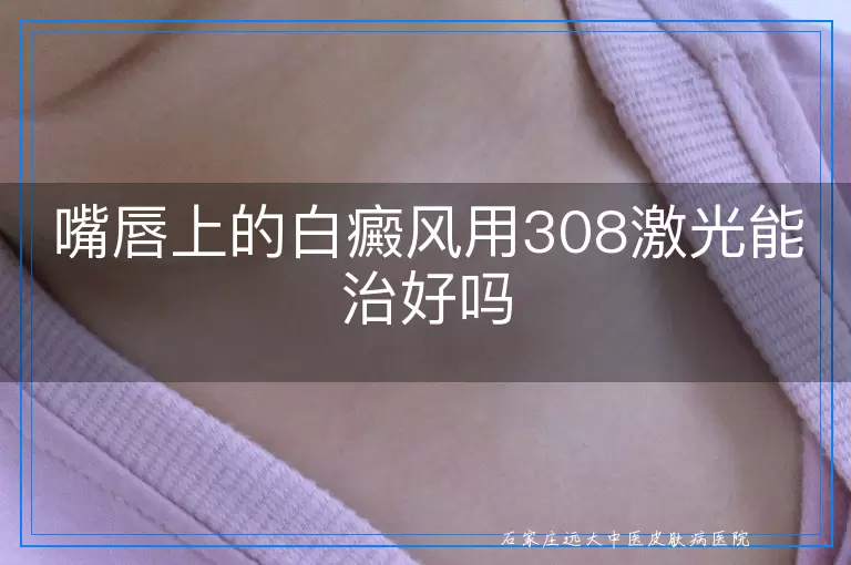 嘴唇上的白癜风用308激光能治好吗