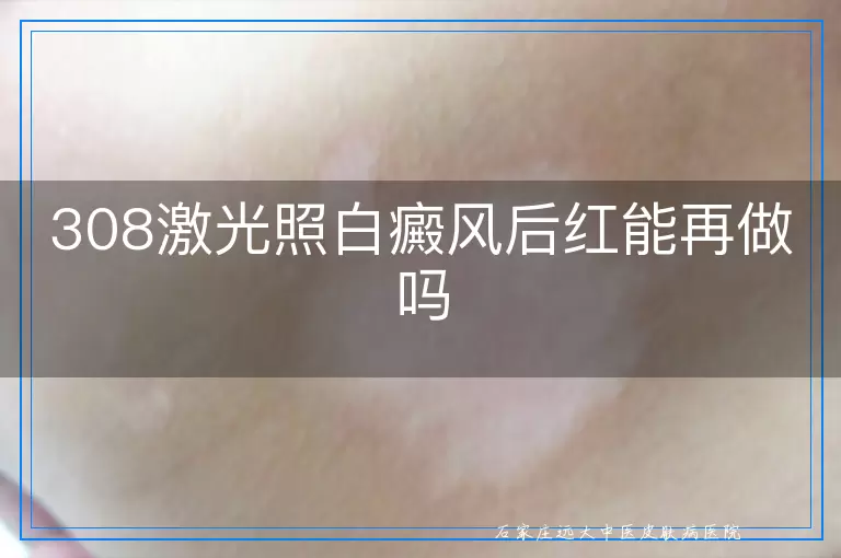 308激光照白癜风后红能再做吗