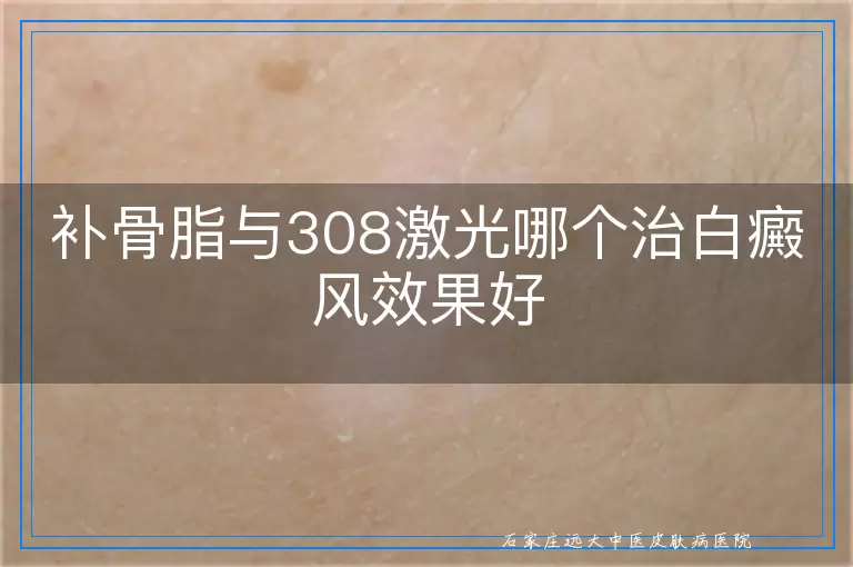 补骨脂与308激光哪个治白癜风效果好