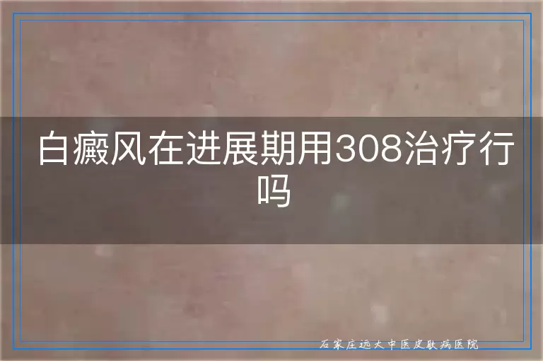 白癜风在进展期用308治疗行吗
