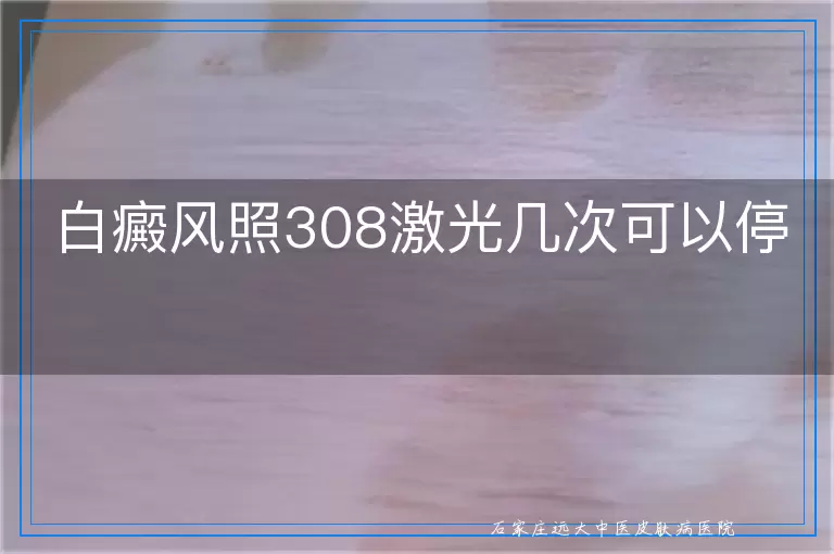 白癜风照308激光几次可以停