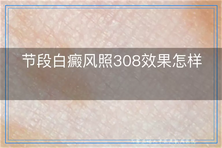 节段白癜风照308效果怎样
