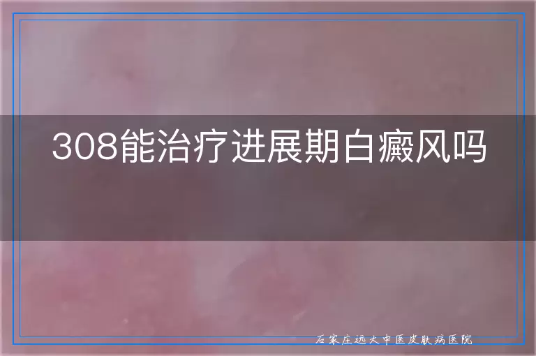 308能治疗进展期白癜风吗