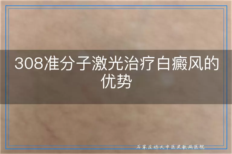 308准分子激光治疗白癜风的优势