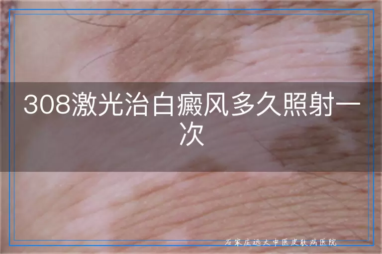 308激光治白癜风多久照射一次