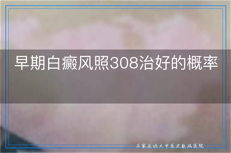 早期白癜风照308治好的概率