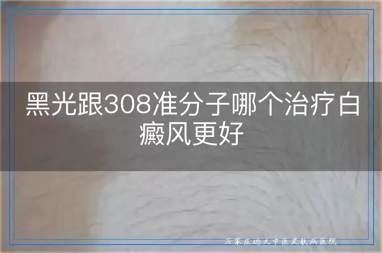 黑光跟308准分子哪个治疗白癜风更好