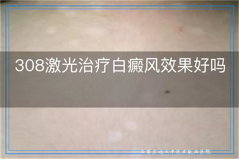 308激光治疗白癜风效果好吗