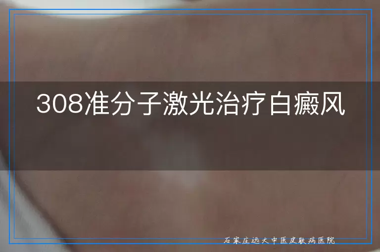 308准分子激光治疗白癜风