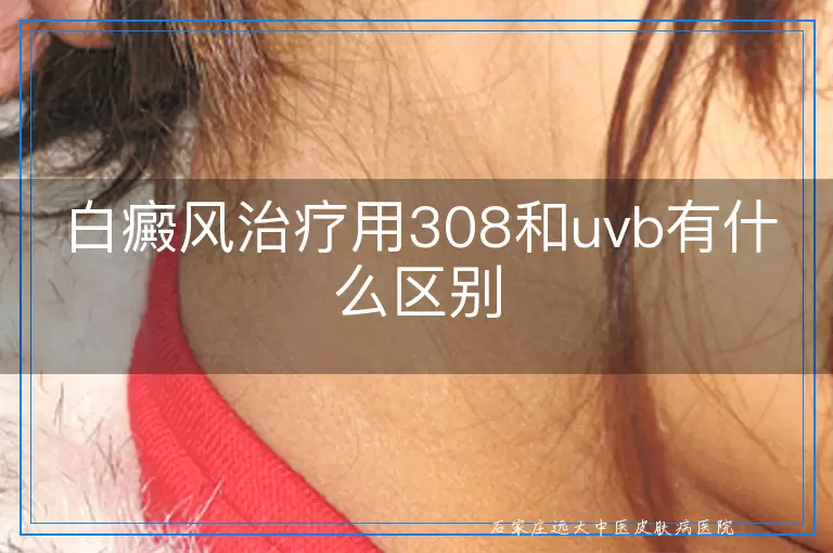 白癜风治疗用308和uvb有什么区别