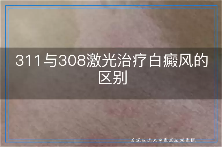 311与308激光治疗白癜风的区别