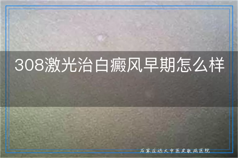 308激光治白癜风早期怎么样