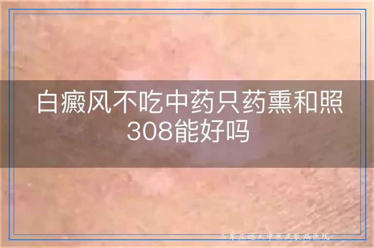 白癜风不吃中药只药熏和照308能好吗