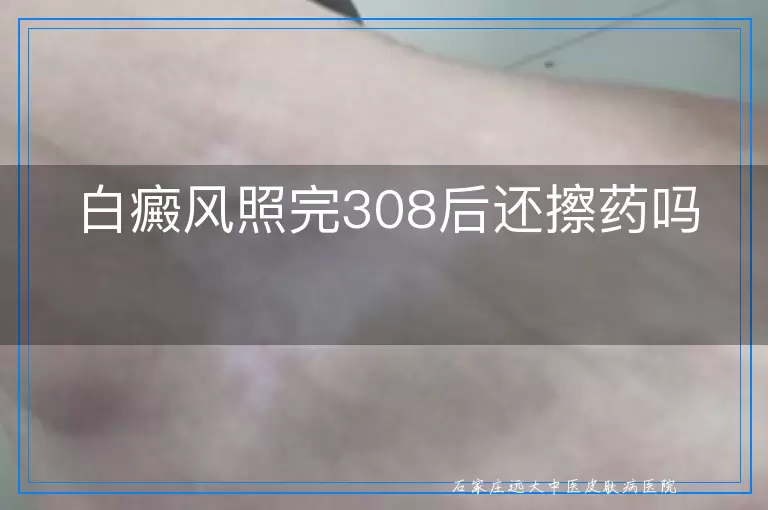 白癜风照完308后还擦药吗