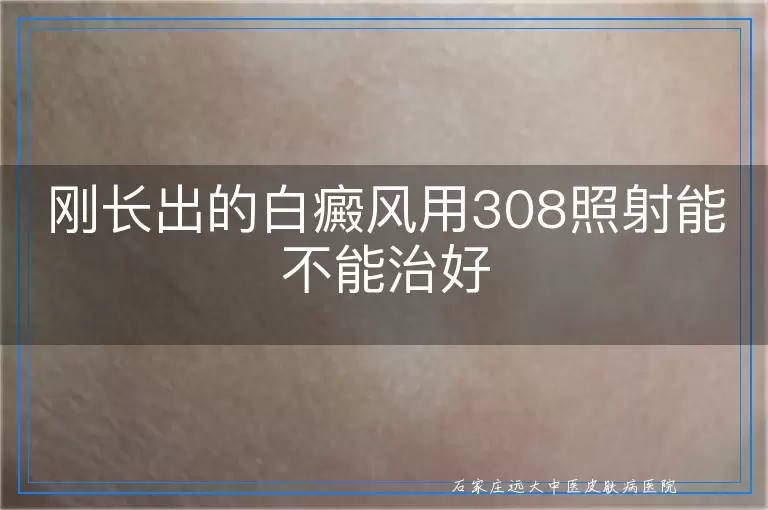 刚长出的白癜风用308照射能不能治好