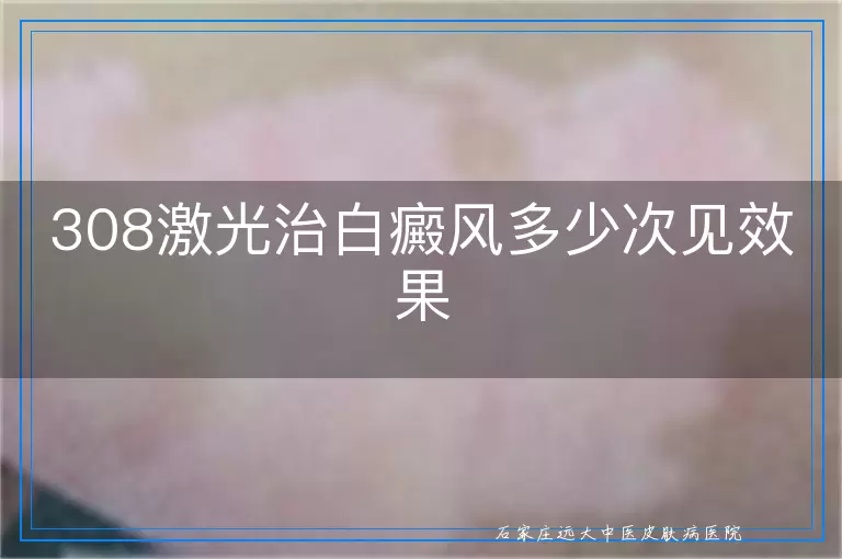 308激光治白癜风多少次见效果