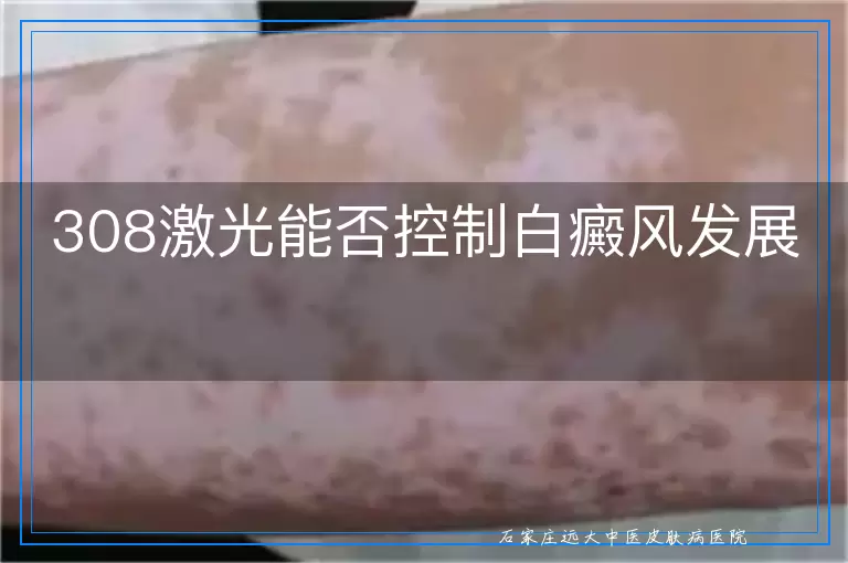 308激光能否控制白癜风发展