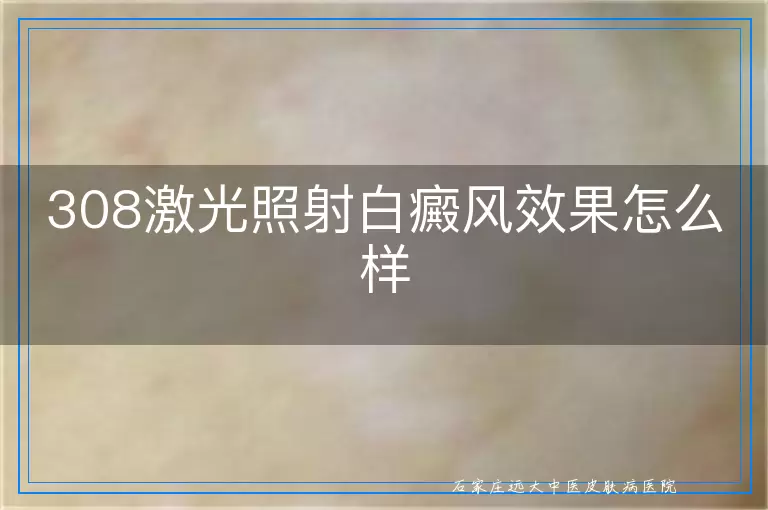 308激光照射白癜风效果怎么样